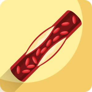 Arterioskleros